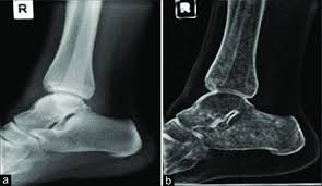 Improving OCR Accuracy